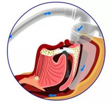无创呼吸机