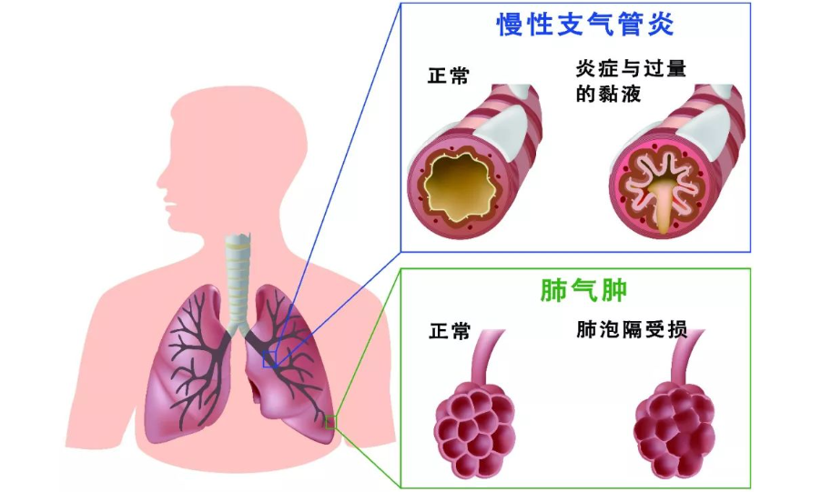 高流量呼吸湿化治疗仪