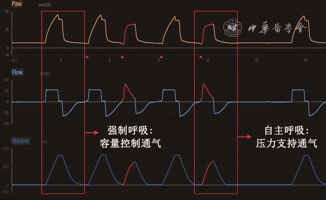 无创呼吸机