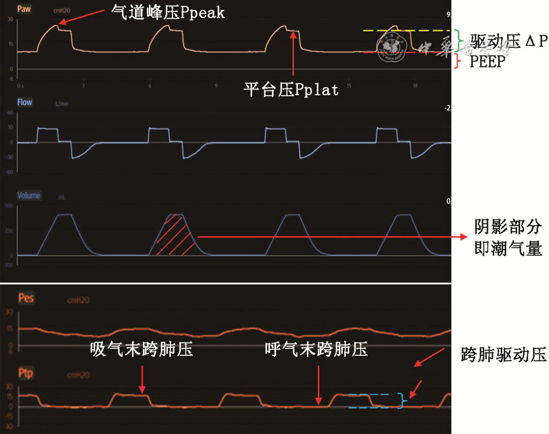 无创呼吸机