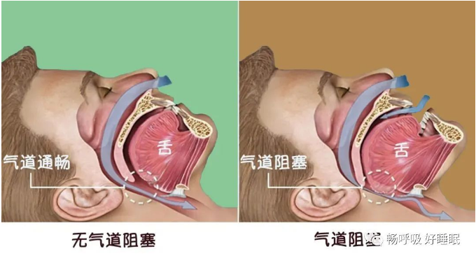 无创呼吸机,高流量呼吸湿化治疗仪,睡眠监测