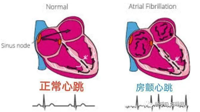 无创呼吸机,高流量呼吸湿化治疗仪,睡眠监测