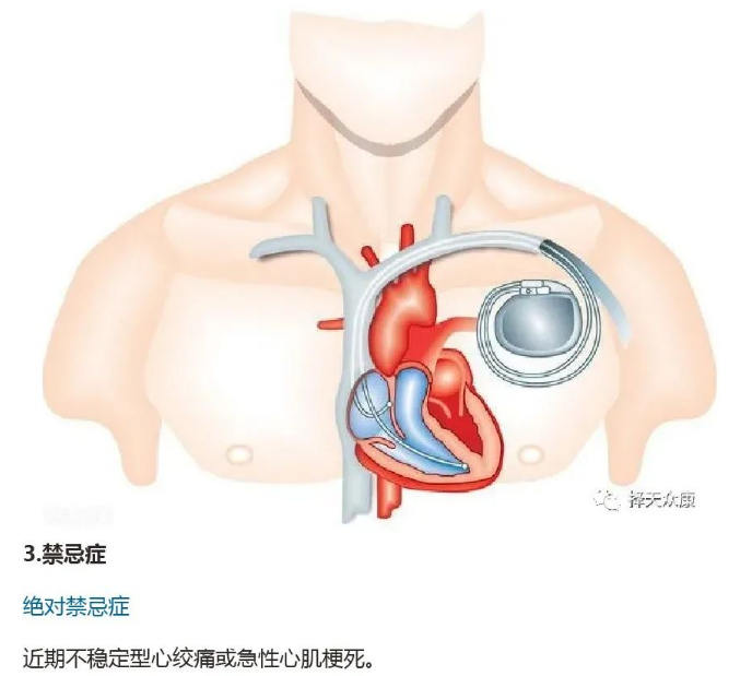 高流量耗材,呼吸机耗材