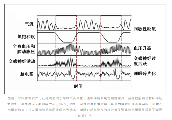 无创呼吸机,高流量呼吸湿化治疗仪,睡眠监测